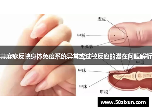 荨麻疹反映身体免疫系统异常或过敏反应的潜在问题解析
